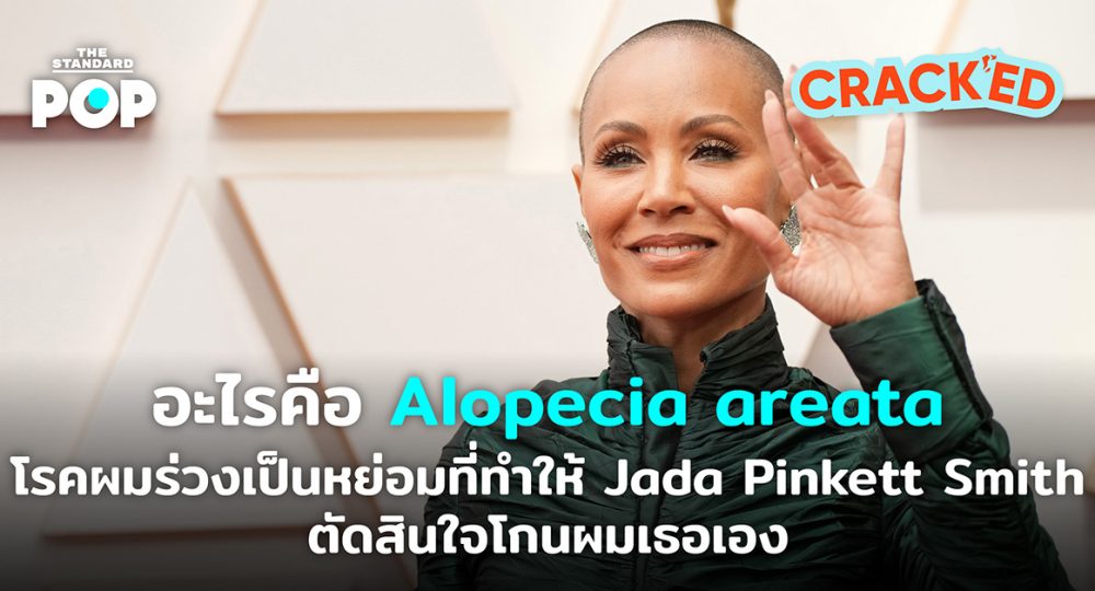 อะไรคือ Alopecia areata โรคผมร่วงเป็นหย่อมที่ทำให้ Jada Pinkett Smith ตัดสินใจโกนผมเธอเอง