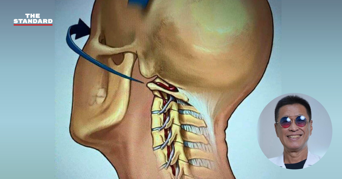 หมอธีระวัฒน์เตือน ‘บิด-สะบัดคอ’ อันตราย ระวังอัมพฤกษ์ แม้บิดไม่แรง ทำซ้ำบ่อยๆ ก็อาจเกิดผลร้ายได้