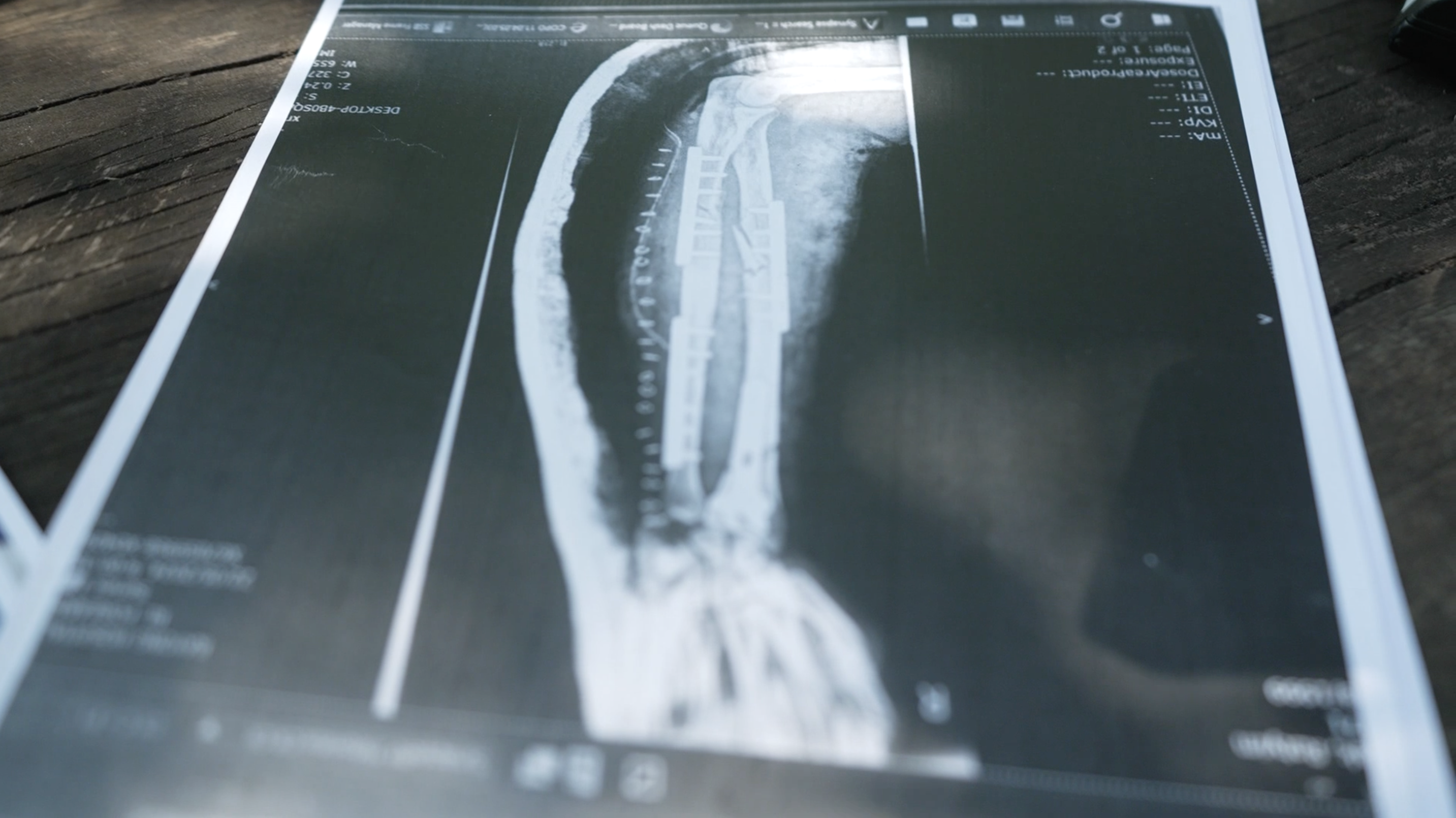 กระดูก xray