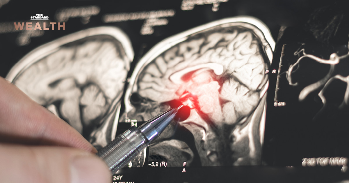 แพทย์กำลังตรวจสอบภาพเอกซเรย์สมองของมนุษย์ ประกอบเนื้อหาเกี่ยวกับหุ่นยนต์ผ่าตัดสมอง YDHB-NS01 ของจีน