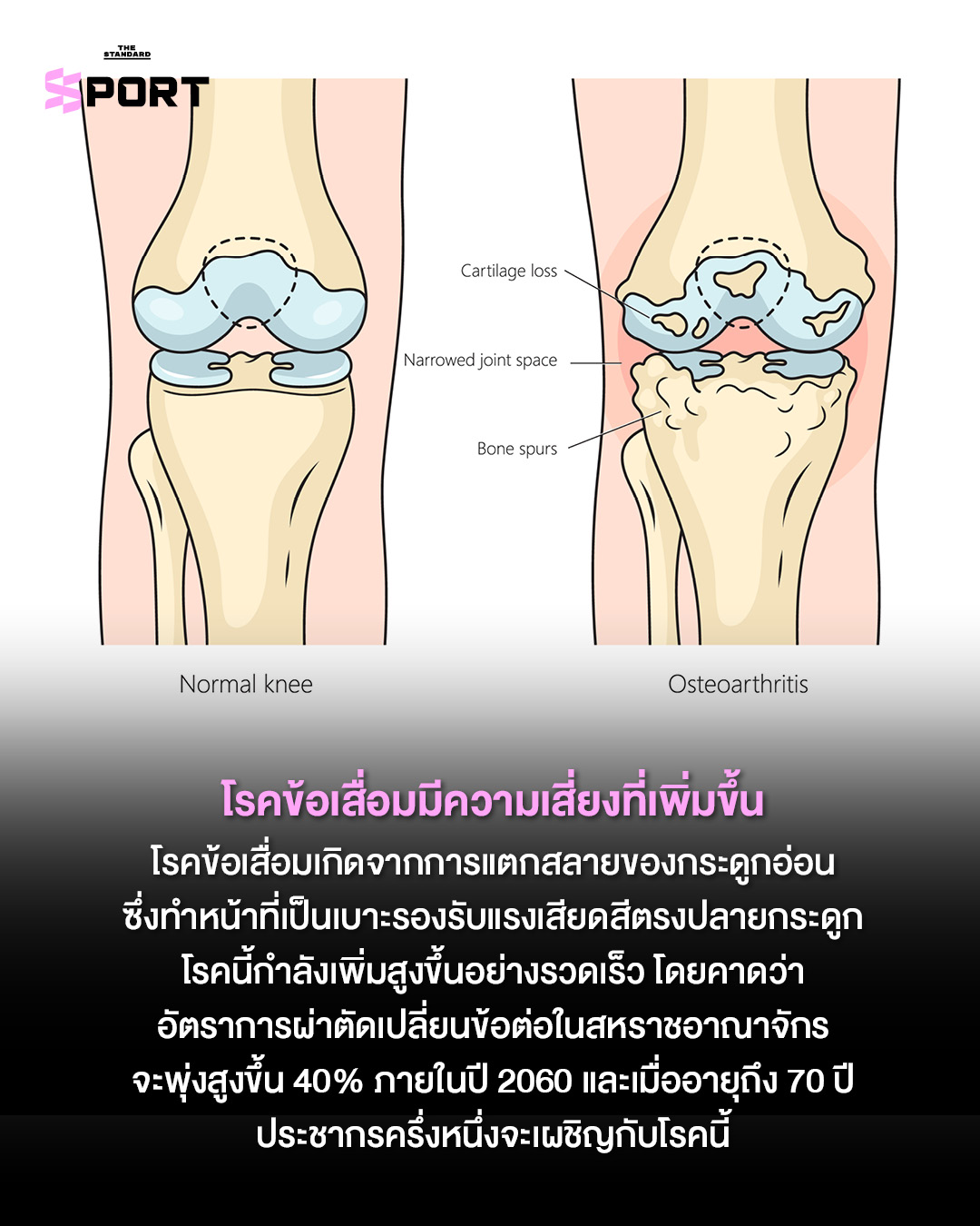 ชายวัยกลางคนแสดงอาการปวดขาจากการออกกำลังกายหนักเกินไป 3